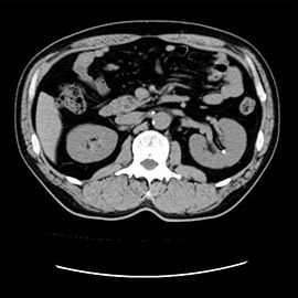 CT撮影画像腹部1