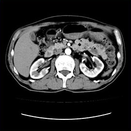 CT撮影画像腹部3