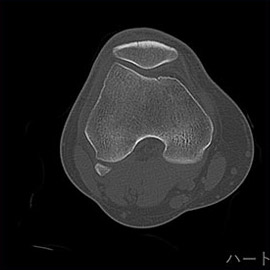 CT撮影画像整形1