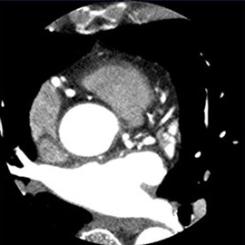 CT撮影画像心臓（冠動脈）1