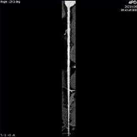 CT撮影画像心臓（冠動脈）4