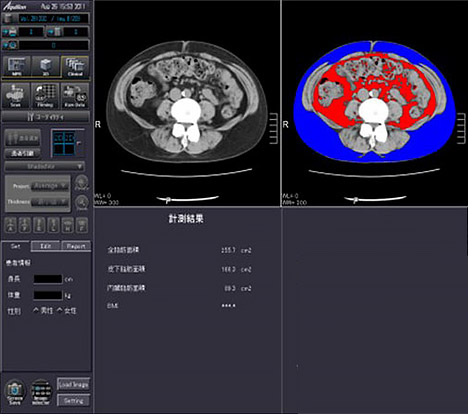 CT撮影画像体脂肪計測1